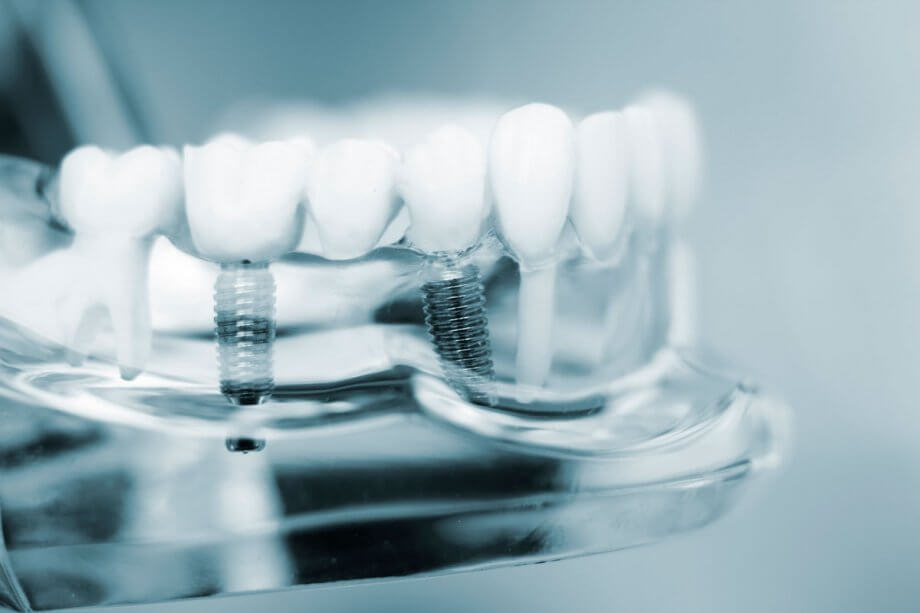 clear plastic model of dental implant