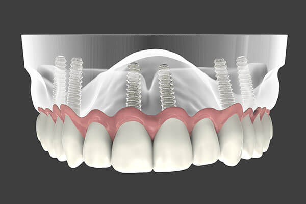 Dental Implant supported denture graphic