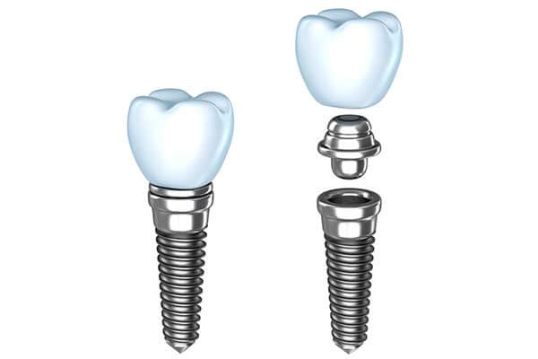 Single Dental Implants in Germantown