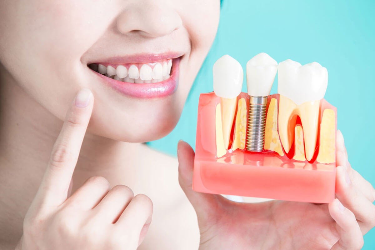 4 Myths About Dental Implants Rosewood Dental