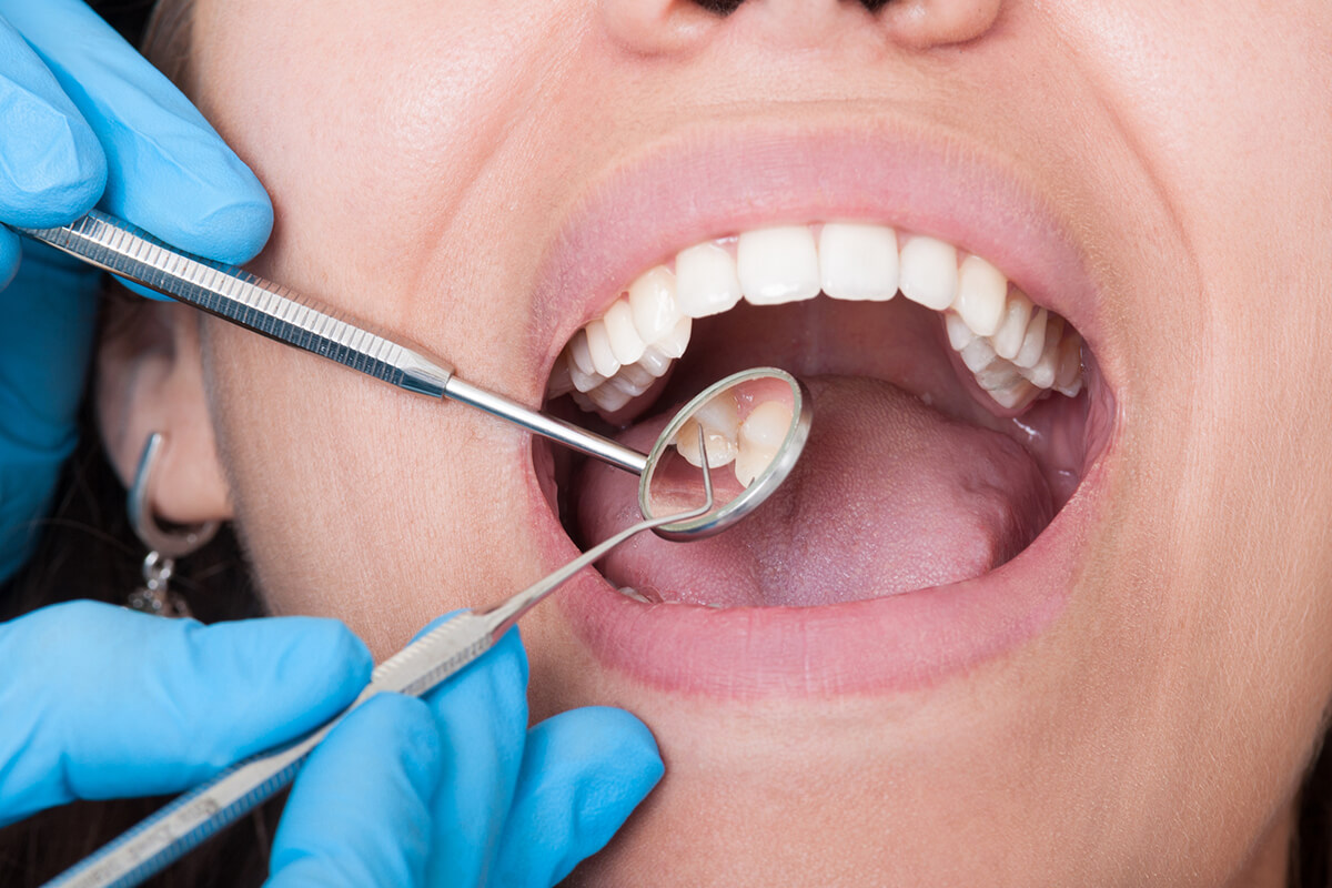 How Often Should You Get Your Teeth Cleaned? Germantown, MD