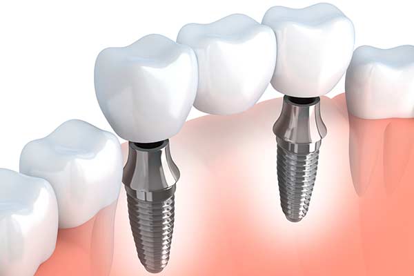 Dental Implant Supported Bridges in Germantown