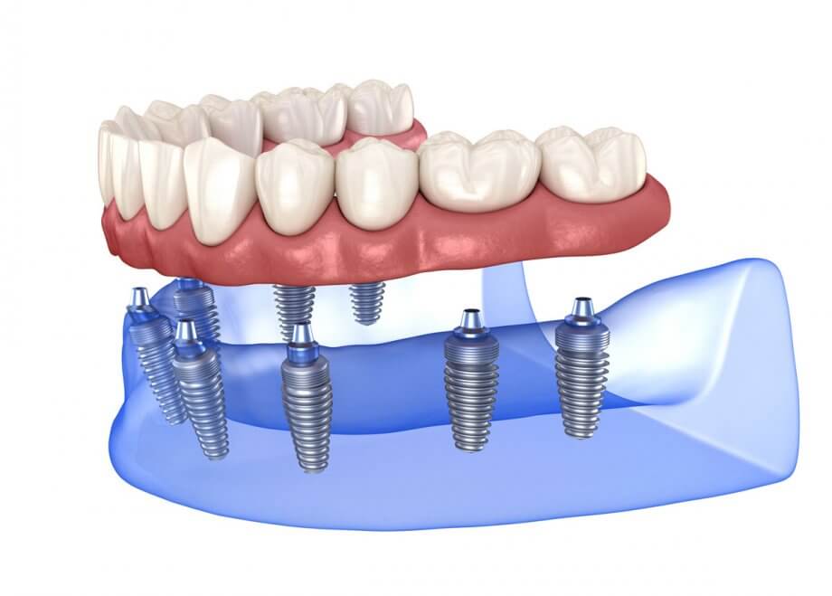 digital image of dentures supported by dental implants