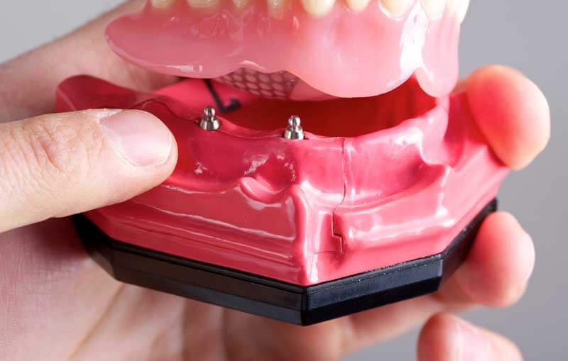 Mini Dental implants in Germantown